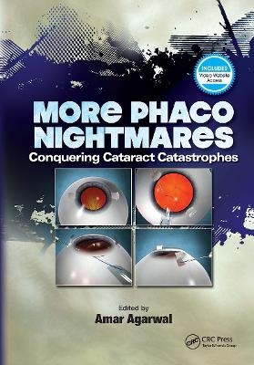 More Phaco Nightmares - Amar Agarwal