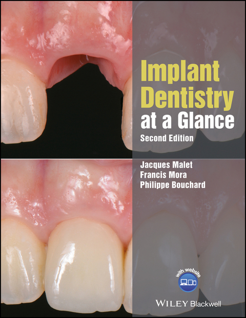 Implant Dentistry at a Glance - Jacques Malet, Francis Mora, Philippe Bouchard