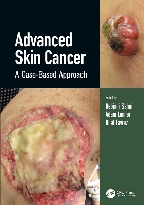 Advanced Skin Cancer - 