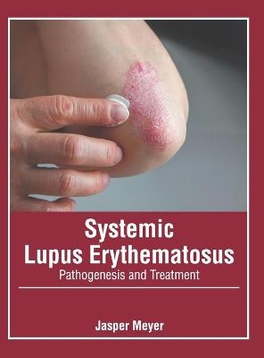 Systemic Lupus Erythematosus: Pathogenesis and Treatment - 