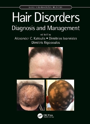 Hair Disorders - 