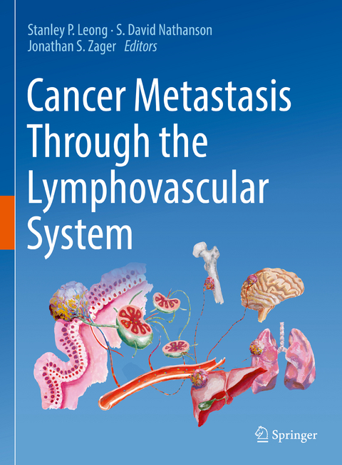 Cancer Metastasis Through the Lymphovascular System - 