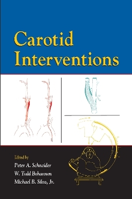 Carotid Interventions - 