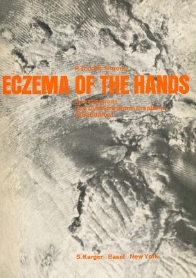 Eczema of the Hands - R.D.G.P. Simons