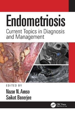 Endometriosis - 