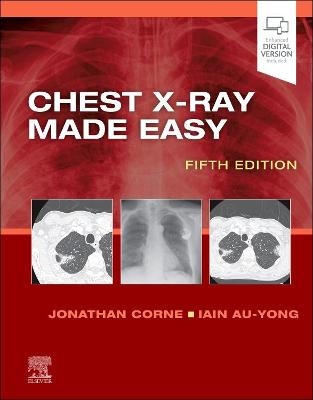 Chest X-Ray Made Easy - Jonathan Corne, Iain Au-Yong