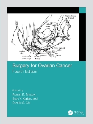 Surgery for Ovarian Cancer - 