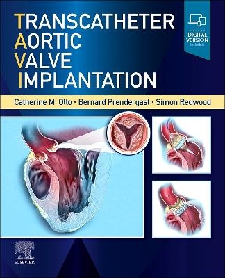 Transcatheter Aortic Valve Implantation - 