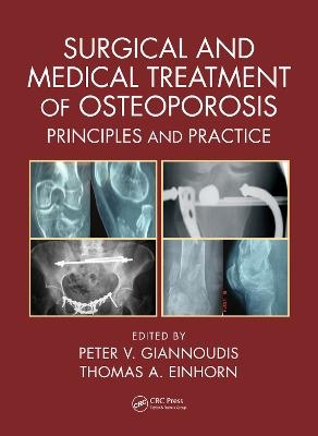 Surgical and Medical Treatment of Osteoporosis - 