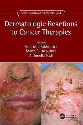 Dermatologic Reactions to Cancer Therapies - 