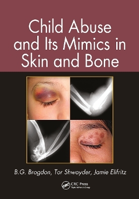 Child Abuse and its Mimics in Skin and Bone - B. G. Brogdon, Tor Shwayder, Jamie Elifritz