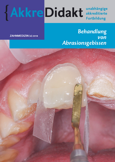 Behandlung von Abrasionsgebissen - Peter Wetselaar, Bas A. C. Loomans, Niek Opdam, Frank Lobbezoo