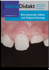 Wurzelunreife Zähne mit Pulpaverletzung - Marga Ree