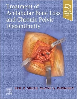 Treatment of Acetabular Bone Loss and Chronic Pelvic Discontinuity - Neil P. Sheth, Wayne Paprosky