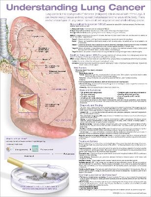 Understanding Lung Cancer Anatomical Chart - 