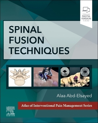 Spinal Fusion Techniques - Alaa Abd-Elsayed