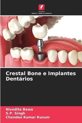 Crestal Bone e Implantes Dentários - Nivedita Bawa, S P Singh, Chandan Kumar Kusum