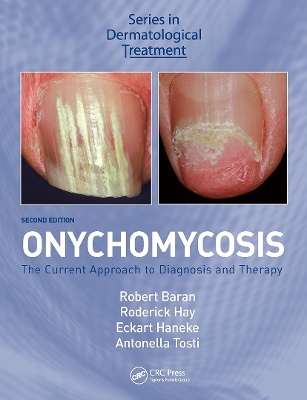 Onychomycosis - 