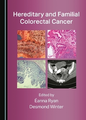 Hereditary and Familial Colorectal Cancer - 