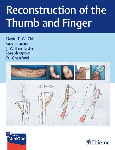 Reconstruction of the Thumb and Finger - 