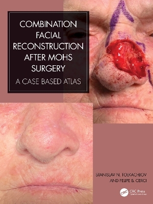 Combination Facial Reconstruction after Mohs Surgery - Stanislav N. Tolkachjov, Felipe B. Cerci