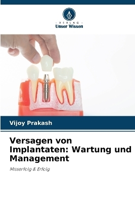 Versagen von Implantaten - Vijoy Prakash