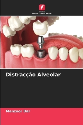 Distracção Alveolar - Manzoor Dar