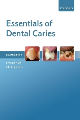 Essentials of Dental Caries - Edwina Kidd, Ole Fejerskov