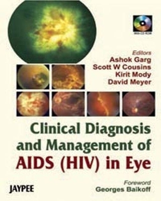 Clinical Diagnosis Management of Aids [HIV] in Eye - Lin Garg