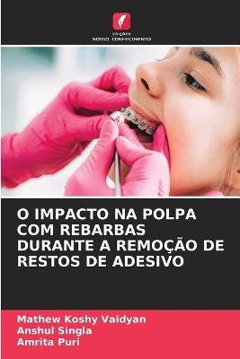 O Impacto Na Polpa Com Rebarbas Durante a Remoção de Restos de Adesivo - Mathew Koshy Vaidyan, ANSHUL SINGLA, Amrita Puri