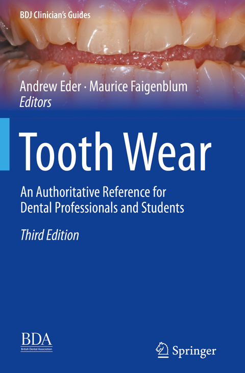 Tooth Wear - 