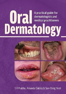 Oral Dermatology - S.R. Prabhu, Amanda Oakley, Sue-Ching Yeoh