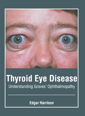 Thyroid Eye Disease: Understanding Graves' Ophthalmopathy - 