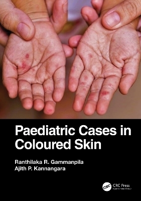 Paediatric Cases in Coloured Skin - Ranthilaka R. Gammanpila, Ajith P. Kannangara