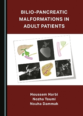 Bilio-Pancreatic Malformations in Adult Patients - Houssem Harbi, Nozha Toumi, Nouha Dammak