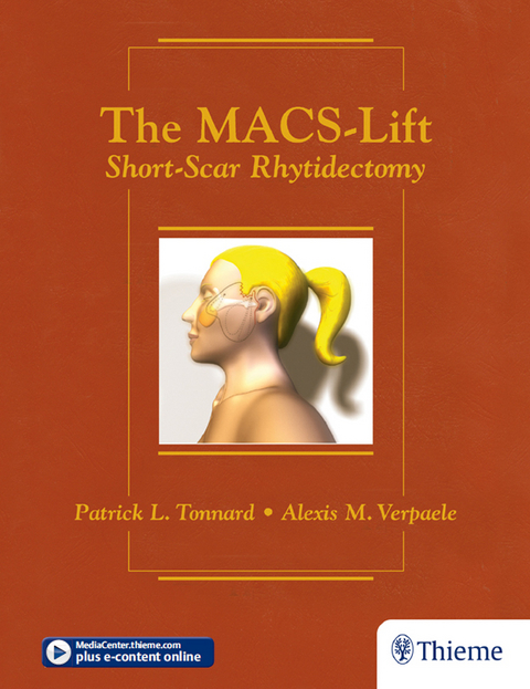 The MACS-Lift - Patrick L. Tonnard, Alexis M. Verpaele