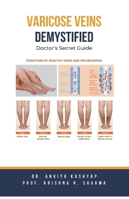 Varicose Veins Demystified - Dr Ankita Kashyap, Prof Krishna N Sharma