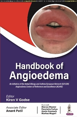 Handbook of Angioedema - Kiran V Godse, Anant Patil