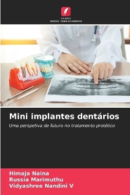 Mini implantes dentários - Himaja Naina, Russia Marimuthu, Vidyashree Nandini V