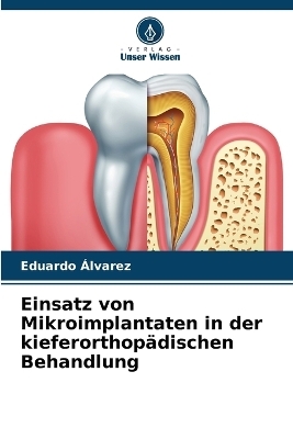 Einsatz von Mikroimplantaten in der kieferorthop�dischen Behandlung - Eduardo �lvarez