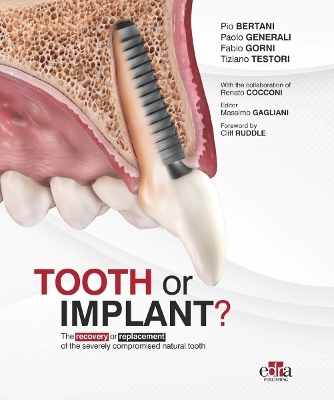 Tooth or Implant - Paolo Generali, Fabio Gorni, Tiziano Testori