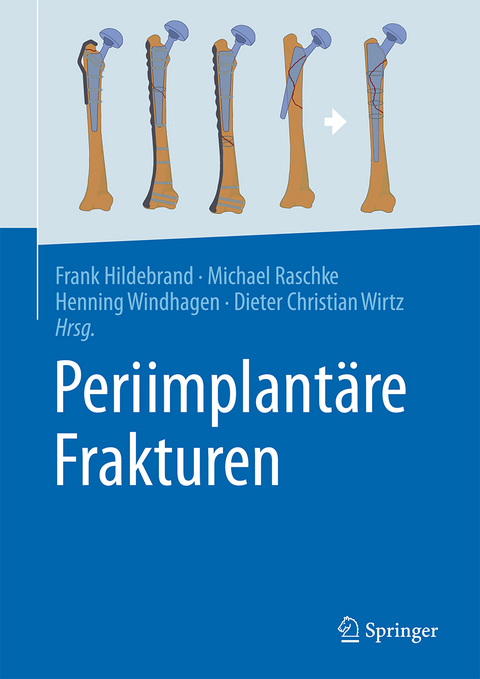 Periimplantäre Frakturen - 