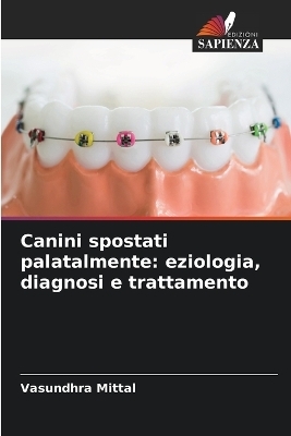 Canini spostati palatalmente - Vasundhra Mittal