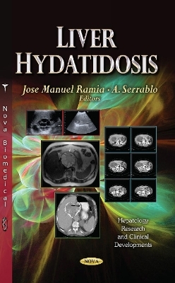 Liver Hydatidosis - 