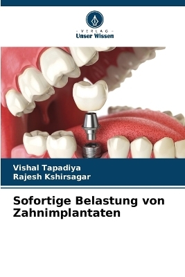 Sofortige Belastung von Zahnimplantaten - Vishal Tapadiya, Rajesh Kshirsagar