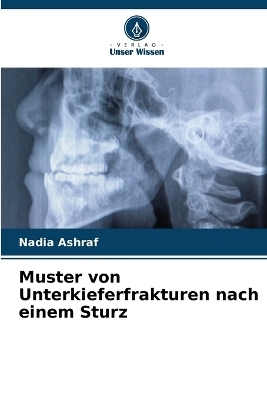 Muster von Unterkieferfrakturen nach einem Sturz - Nadia Ashraf