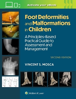 Foot Deformities and Malformations in Children - Vincent Mosca