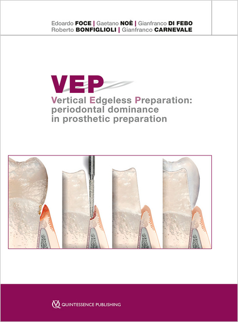 VEP Vertical Edgeless Preparation - Edoardo Foce, Gaetano Noè, Gianfranco Di Febo, Roberto Bonfiglioli, Gianfranco Carnevale