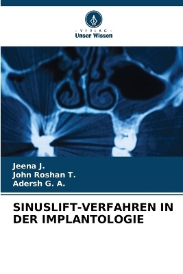 Sinuslift-Verfahren in Der Implantologie - Jeena J, John Roshan T, Adersh G a