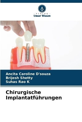 Chirurgische Implantatführungen - Ancita Caroline D'souza, Brijesh Shetty, Suhas Rao K